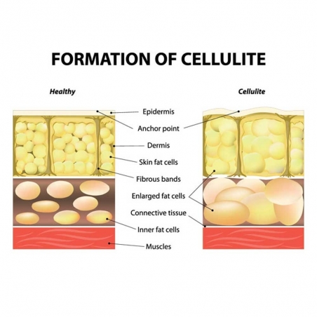 Anticeluliten-masazor-Celluless-MD-don_100028