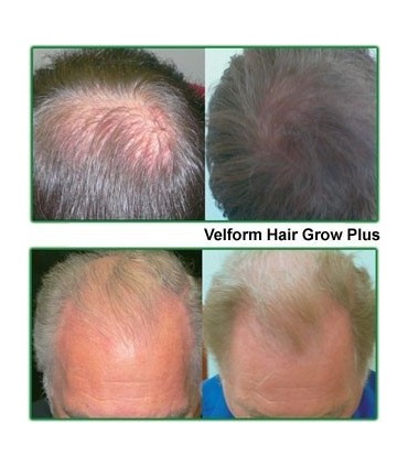 Уред против косопад Power Grow Comb