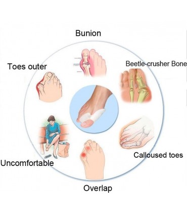 Силиконови Разделители Срещу Изпъкнали Кокалчета