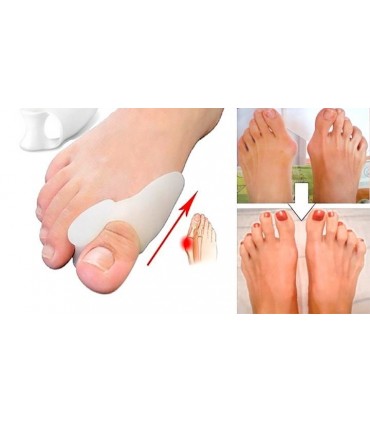 Силиконови Разделители Срещу Изпъкнали Кокалчета